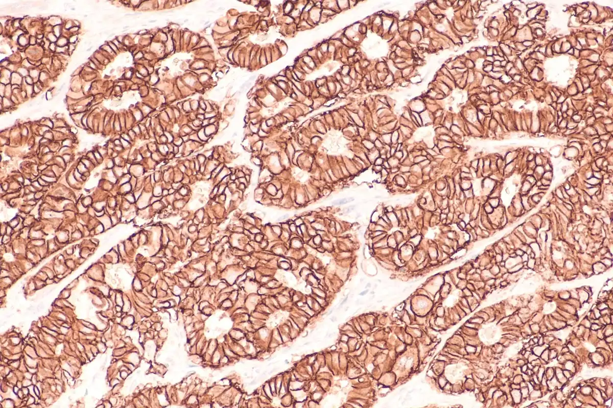 Pathologie Dres. med. Rudolf & Kollegen aus Hoyerswerda und Bautzen – Immunhistologie Immunhistologie